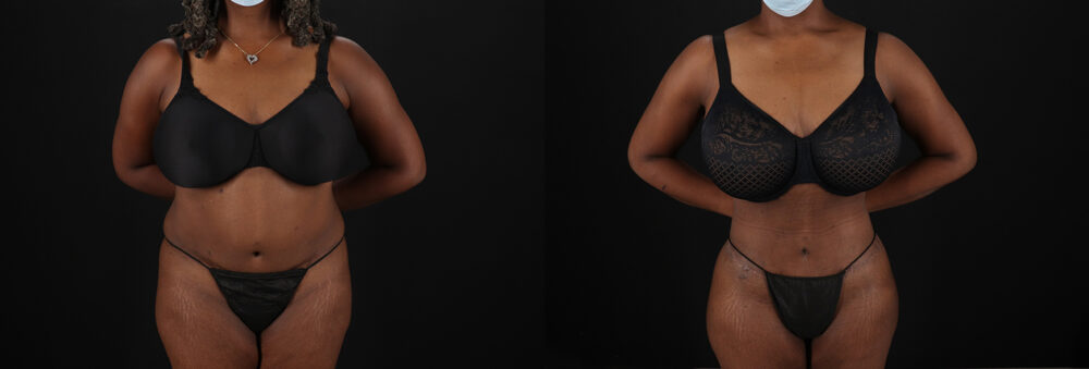 Brazilian Butt Lift case #5271