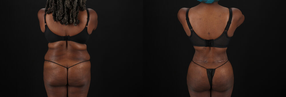 Brazilian Butt Lift case #5271