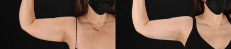 Tummy Tuck case #7465