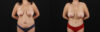 Tummy Tuck case #7626 slider thumbnail