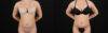Liposuction case #6119 slider thumbnail