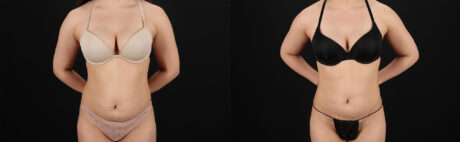 Liposuction case #6119