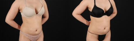 Liposuction case #6119