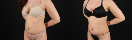 Liposuction case #6119