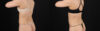 Liposuction case #6119 slider thumbnail