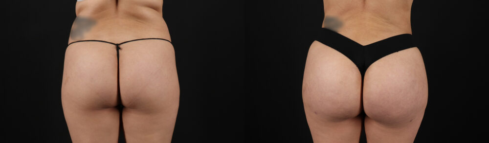 Brazilian Butt Lift case #5390