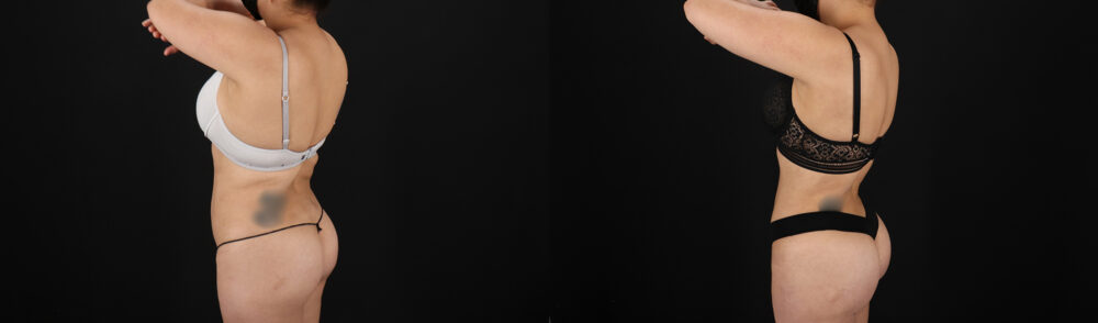 Brazilian Butt Lift case #5390