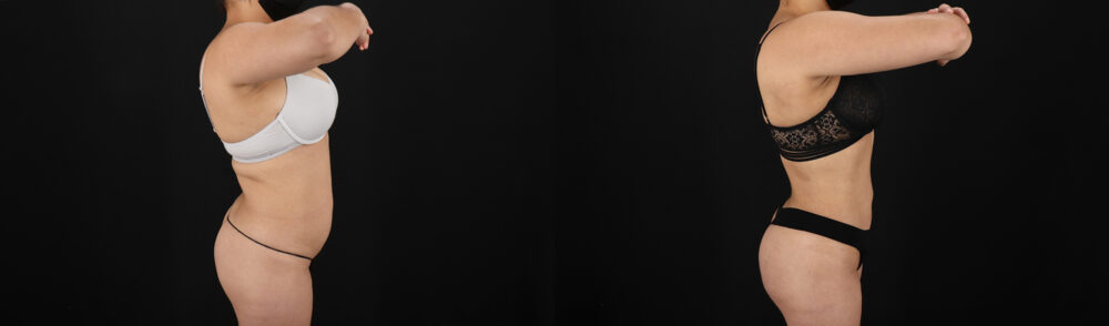 Brazilian Butt Lift case #5390