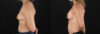 Breast Augmentation case #6408 slider thumbnail