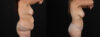 Tummy Tuck case #7470 slider thumbnail