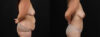Tummy Tuck case #7470 slider thumbnail
