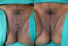 Labiaplasty case #5776 slider thumbnail