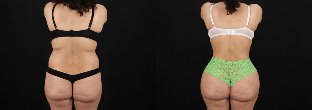 Brazilian Butt Lift case #5391