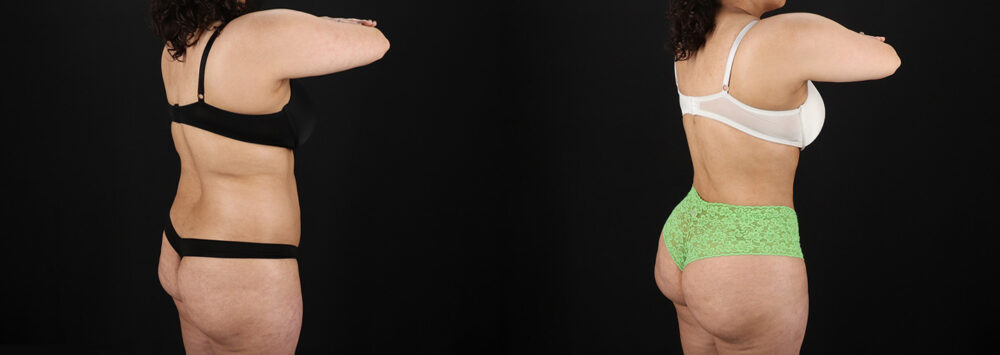 Brazilian Butt Lift case #5391