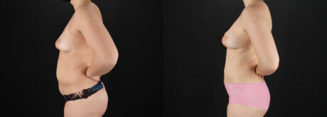 Liposuction case #6120