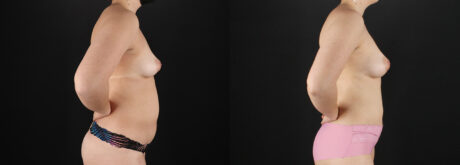 Liposuction case #6120