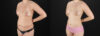 Liposuction case #6120 slider thumbnail