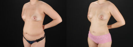 Liposuction case #6120