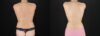 Liposuction case #6120 slider thumbnail