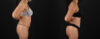 Tummy Tuck case #7472 slider thumbnail