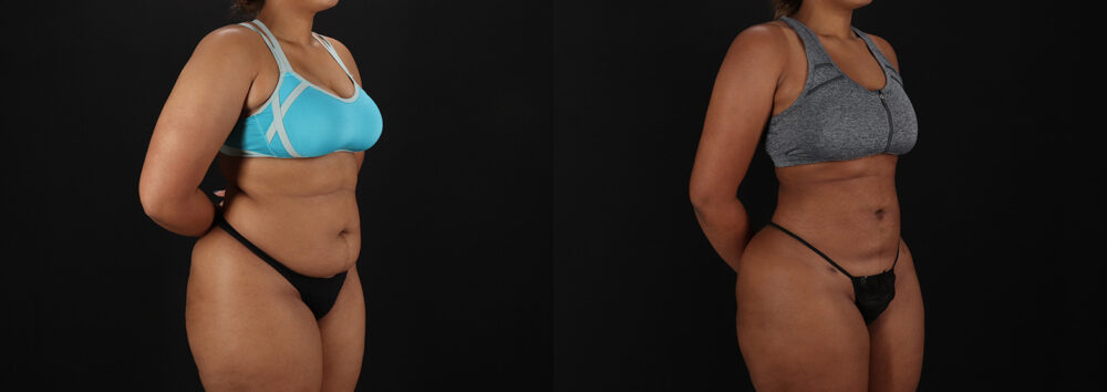 Brazilian Butt Lift case #5513