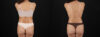 Liposuction case #6121 slider thumbnail