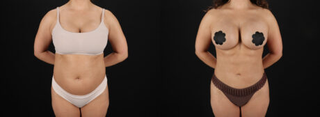 Liposuction case #6121