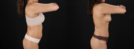 Liposuction case #6121