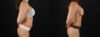 Liposuction case #6121 slider thumbnail