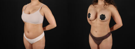Liposuction case #6121