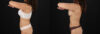 Liposuction case #6121 slider thumbnail