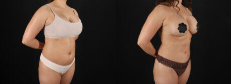 Liposuction case #6121