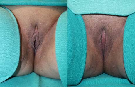 Labiaplasty case #5792