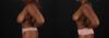 Breast Reduction case #8000 slider thumbnail