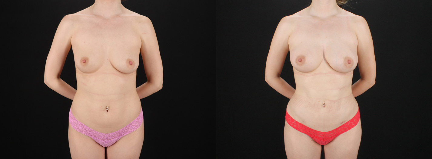 17214-65761-Fat-Grafting-to-the-Breast-before-and-after-photo-by-Dr.-Erika-A.-Sato-in-Houston-TX