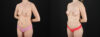Fat Grafting to the Breast case #256214 slider thumbnail