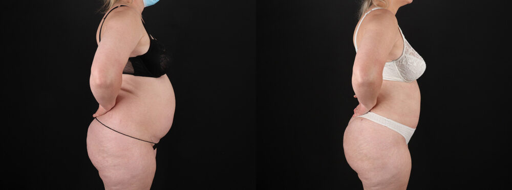 Brazilian Butt Lift case #5393