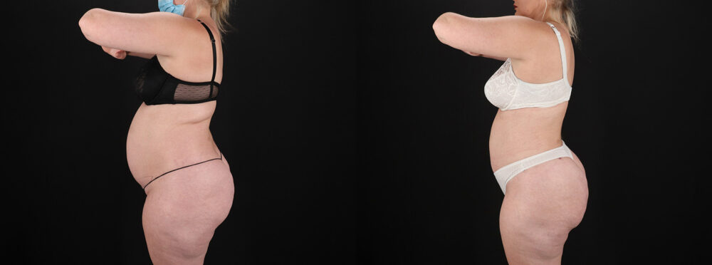 Brazilian Butt Lift case #5393