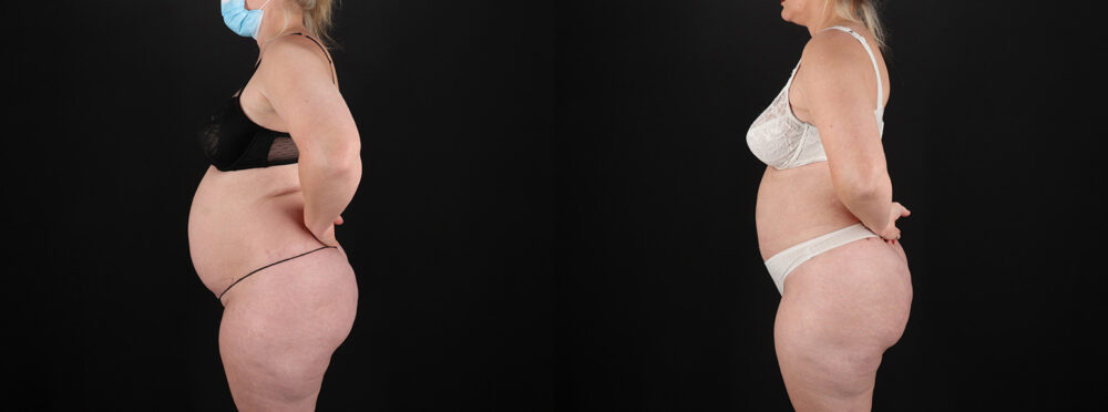 Brazilian Butt Lift case #5393