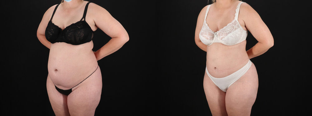 Brazilian Butt Lift case #5393