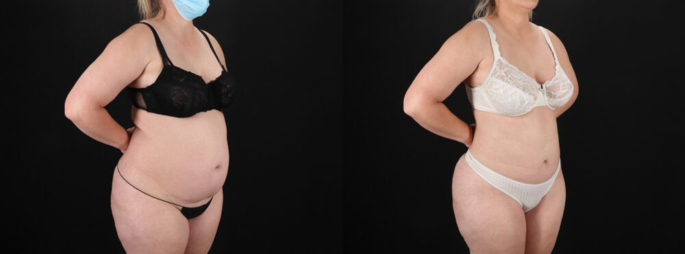 Brazilian Butt Lift case #5393