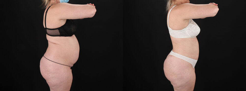 Brazilian Butt Lift case #5393