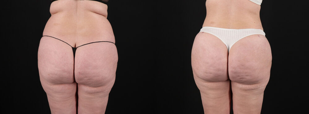 Brazilian Butt Lift case #5393