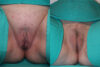 Labiaplasty case #5791 slider thumbnail