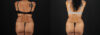 Tummy Tuck case #7616 slider thumbnail
