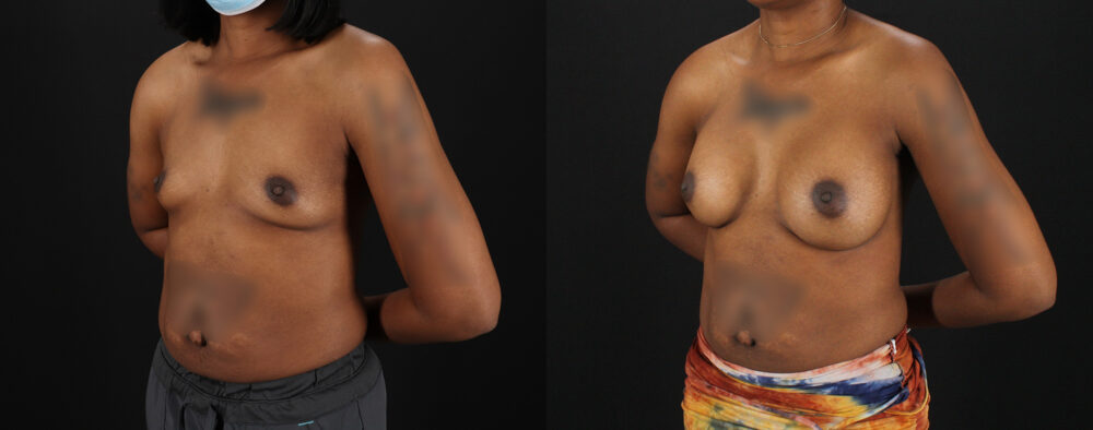 Breast Augmentation case #6432