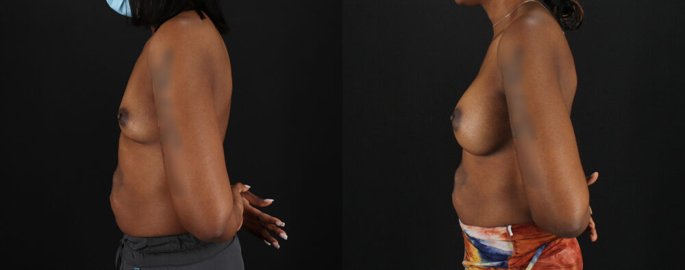 Breast Augmentation case #6432