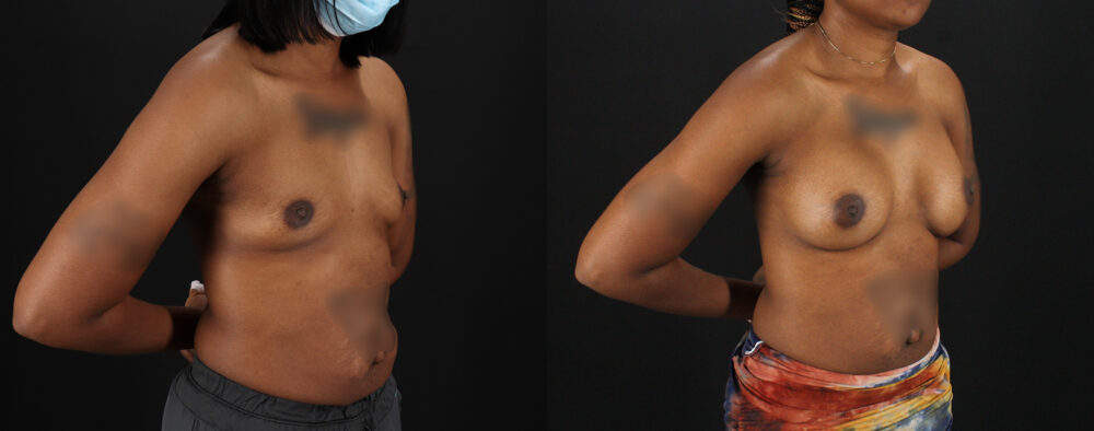 Breast Augmentation case #6432