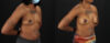Breast Augmentation case #6432 slider thumbnail
