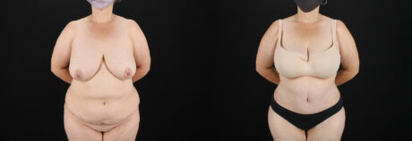 Tummy Tuck case #7615